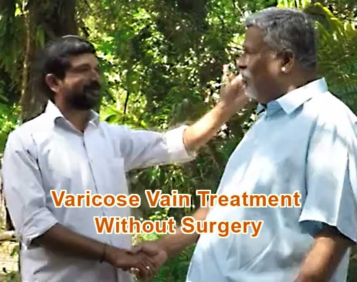 varicose veins patient testimonial reviews success story remedy siddha vaidyam vaidyan kalari treatment marma thirunmmu chikitsa chikilsa center hospital non surgical procedure treatment without surgery gurukkal jose vaidyar cherthala kizhi ayurvedic massage alappuzha Kottayam ernakulam kerala